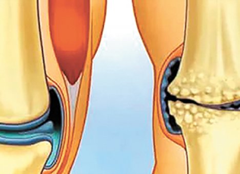 Боли при артрозе коленного сустава поможет облегчить гимнастика